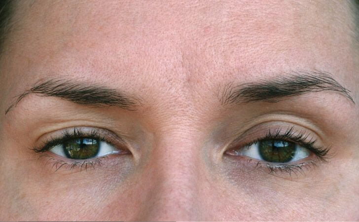 What Are the Causes of Eyelid Ptosis and How to Treat It | Dr. Egozi Plastic Surgery Tampa, FL - close up of Ptosis eyes