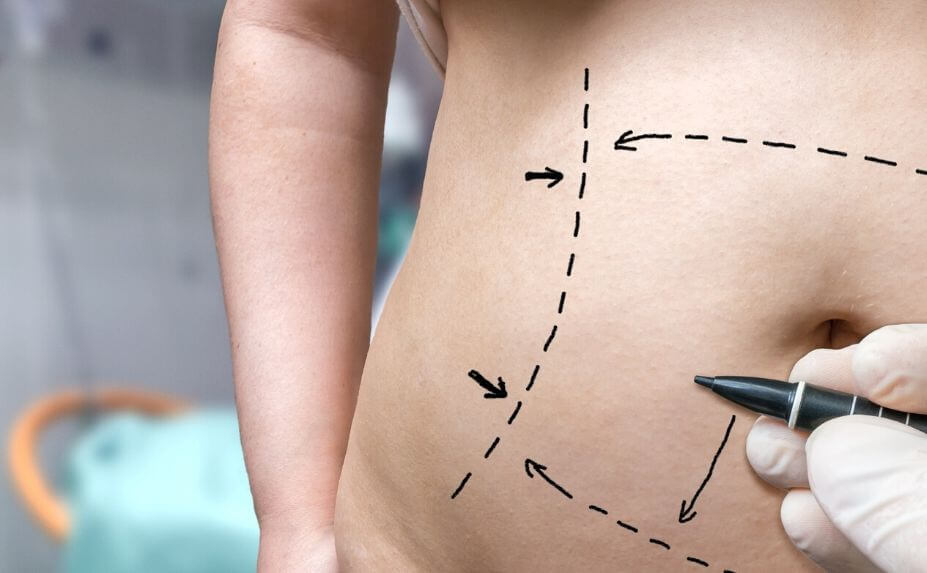Tummy Tuck Facts You